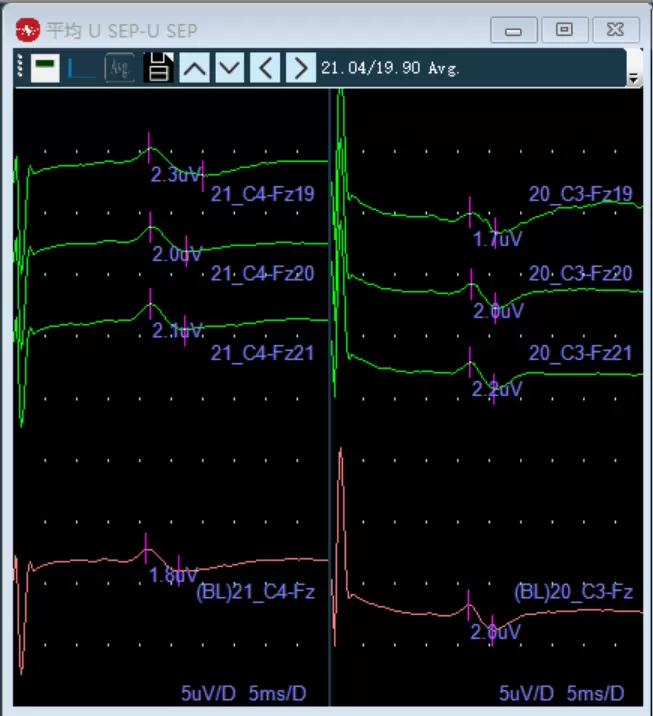 Intraoperative electrophysiological monitoring