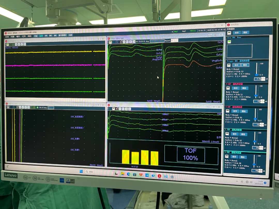 Precisely Disarming the "Nerve Bomb": Intraoperative Neurophysiological Monitoring Guides Complex Malignant Melanoma Resection